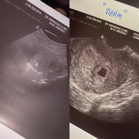 ท้องอ่อนๆ