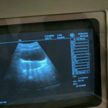 bun aq mau nanya aq kemarin tgl 7 Desember aq udah telat 10 hri ehh di tp negatif terus aq usg kan saking pngn ngertinya sebenarnya aq kenapa pas usg kata doketernya udah ada kantongnya terus aq tp lagi negatif terus aq tgl 14 kemarin aq priksa lagi ke bi