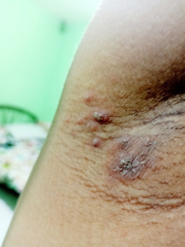 help!! pimple like sa armpit!