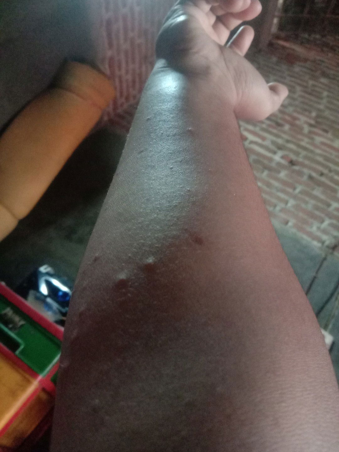 gejala gatal pd kehamilan 3bln...