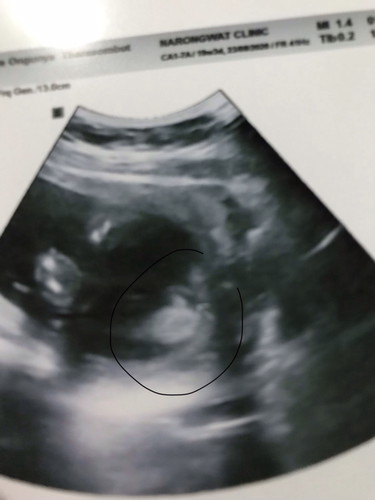 อัลตร้าซาว