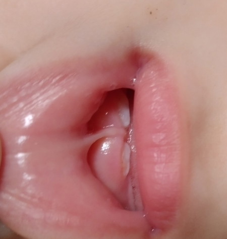 Lip Tie