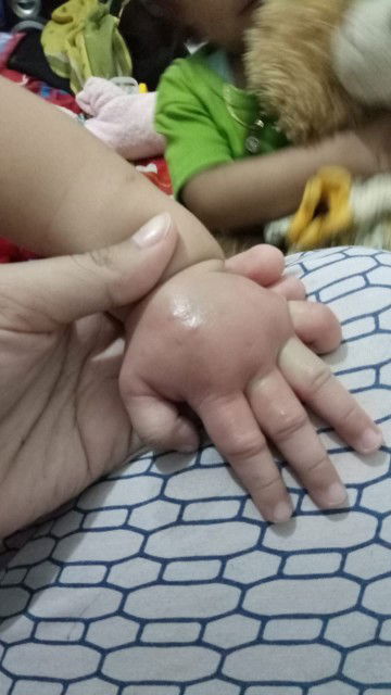 tangan bengkak digigit serangga