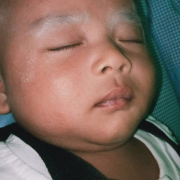 obat bruntusan buat pipi