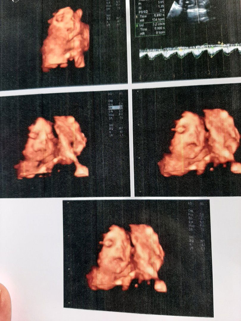 thai 30 tuần 3 ngày