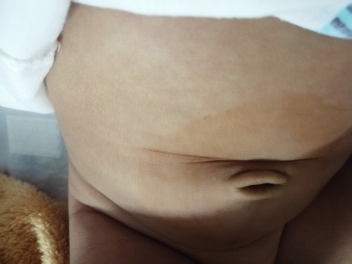 ท้องของลูก จะ2เดือน บุ๋มลงไปแปลกๆ มีลูกใครเคยเป็นบ้างคะ อันตรายไหม