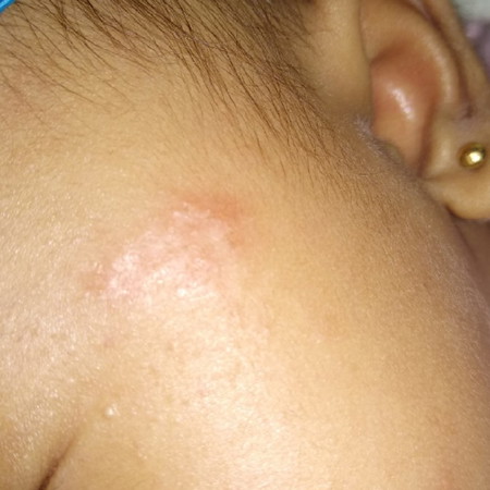merah di pipi bayi