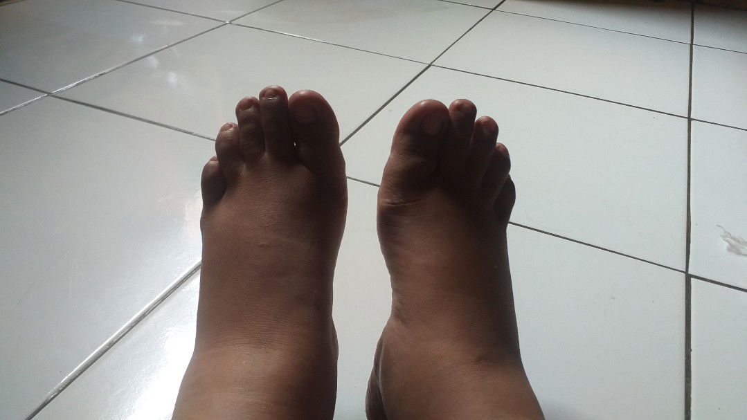 kaki membengkak