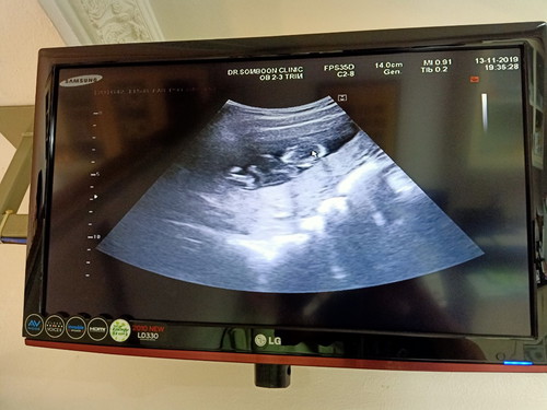 หนูดั้งโด่งนะค้าาา หมอบอก #18W4D