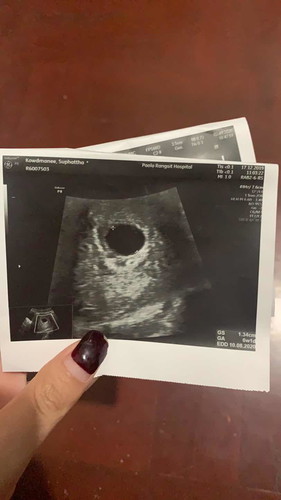 อัลตราซาวด์ไม่เจอตัวเด็ก