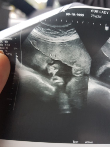Finally Ultrasound! ?