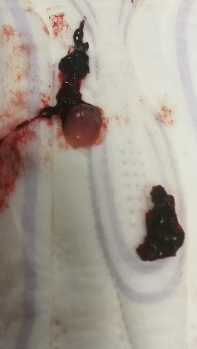 Miscarriage baby sac?