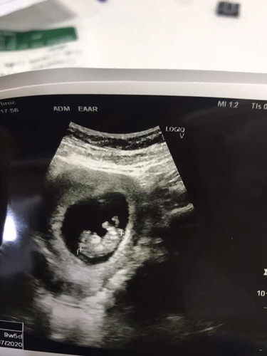 ท้องแรก เป็นริดสีดวง ทรมานมากเลยค่ะ ทำไงถึงจะหายค่ะ