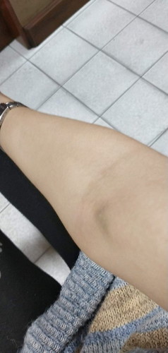 สาเหตุคือการเจาะเลือดตรวจโรค..