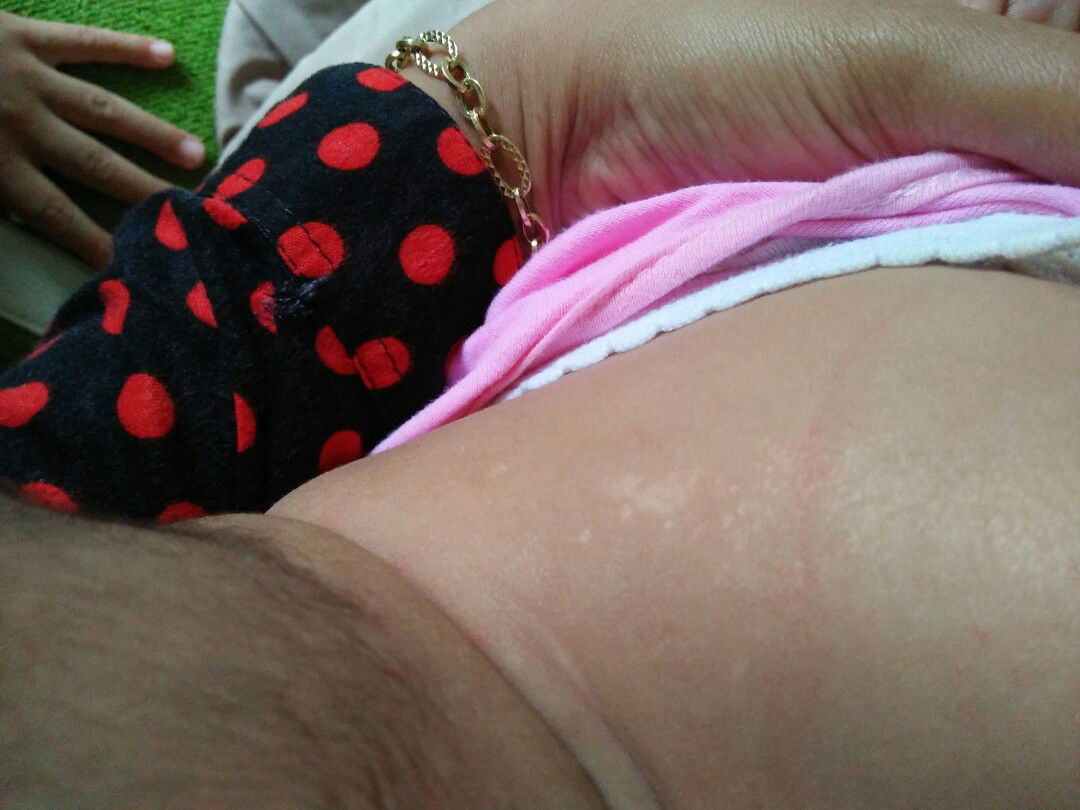 bintik2 putih dikulit