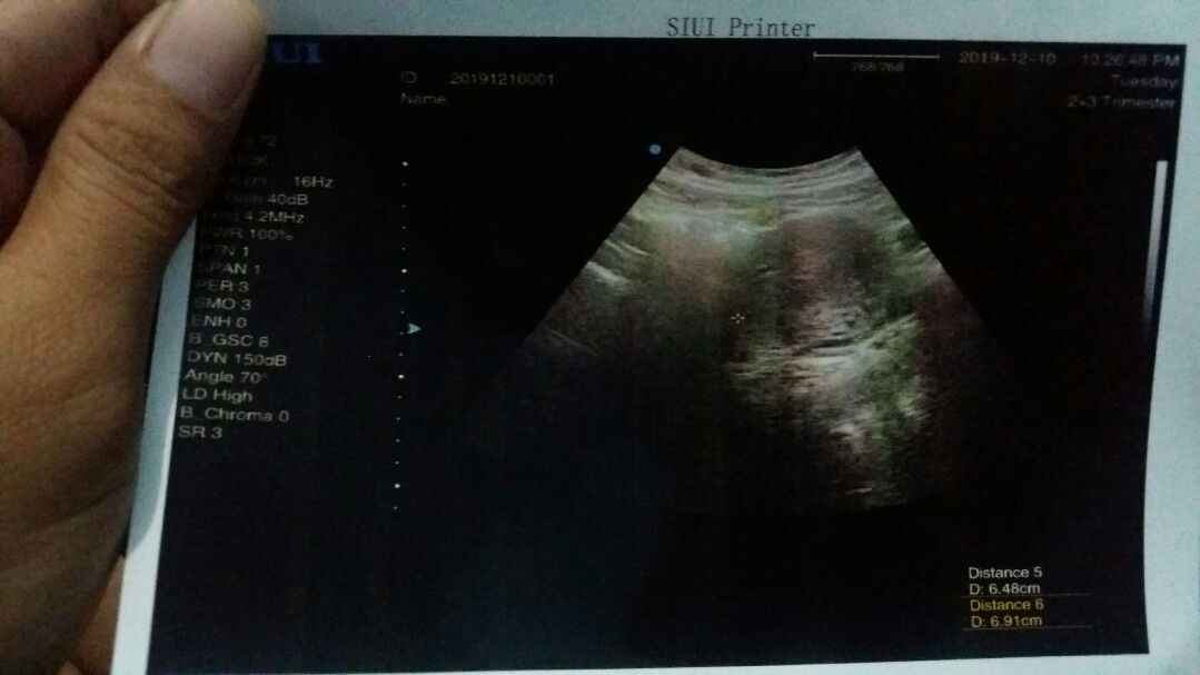 Bingung di awal kehamilan