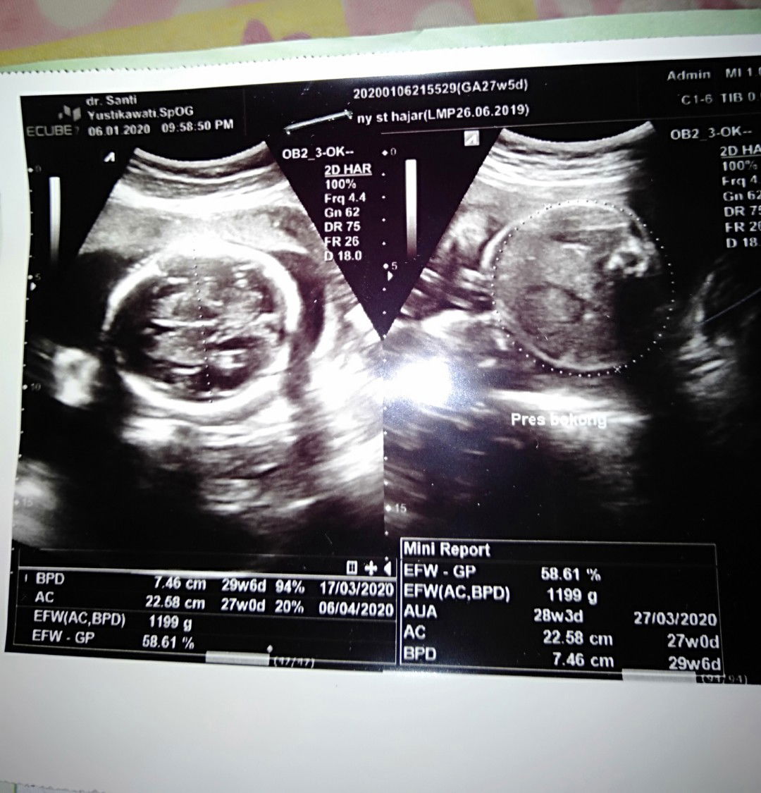 Bedanya cairan vagina dengan cairan ketuban?