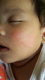 Rash on baby's face