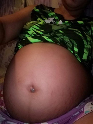 stretch mark ?