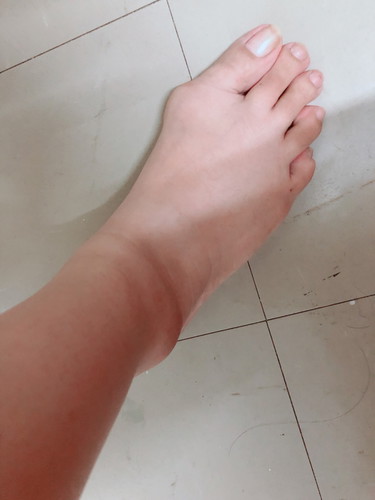 22w เท้าบวม แต่มือไม่บวม ผิดปกติมั้ยคะ?