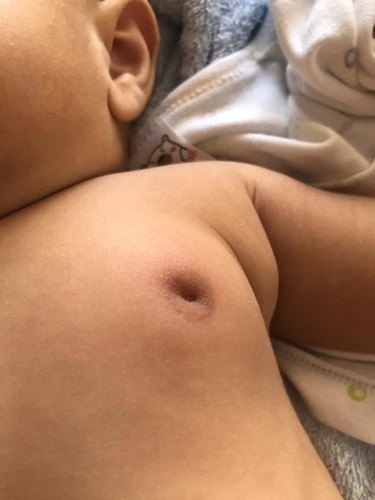 หัวนมลูกอักเสบ