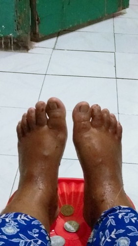 kaki bengkak