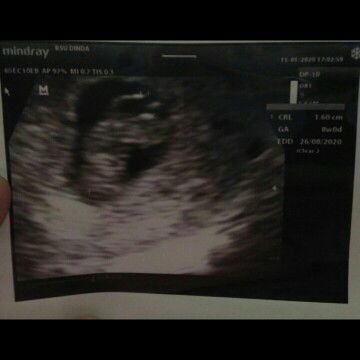 Flek terus warna coklat di usia 8W