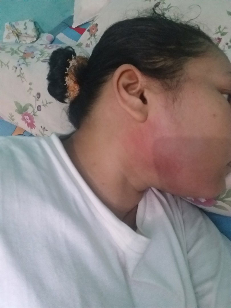 kulit kemerahan di sekitar telinga  kiri n kanan