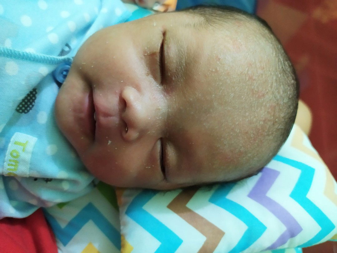 keluar bintik" merah dan biang