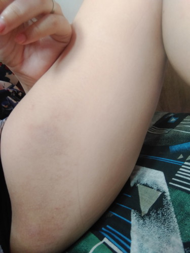 ask lang po mga momshie anong rashes to?? sino nagkakaroon ng ganito po??? 3months preggy po ako..