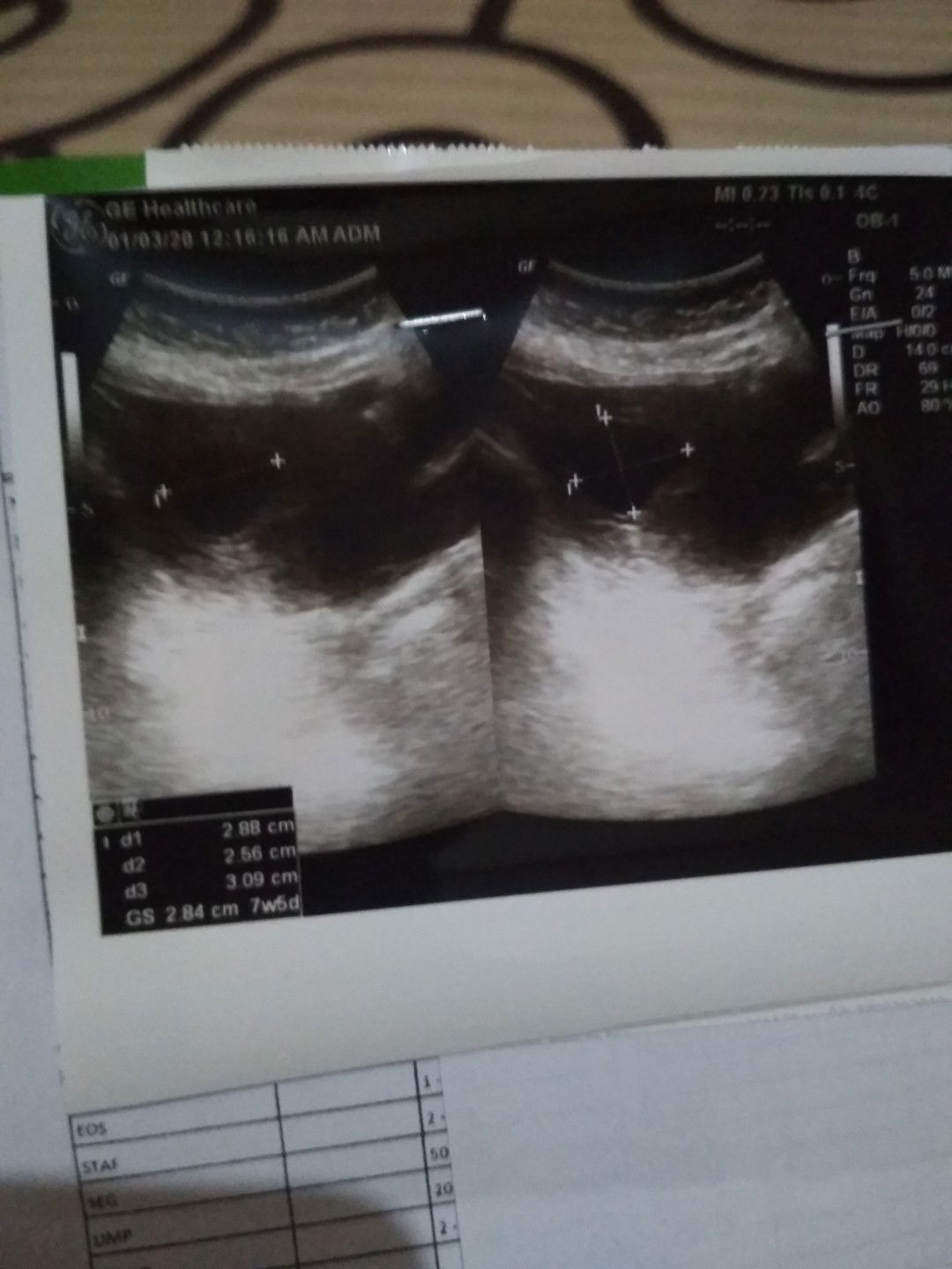 hamil kosong janin tidak berkembang