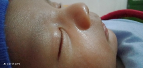 bintik merah di pipi