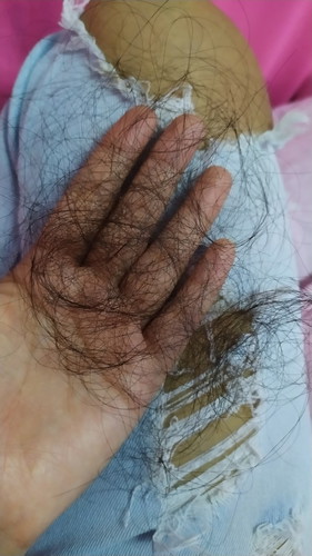 ผมร่วงหนักมากค่ะ