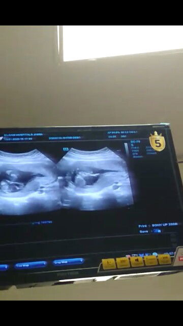 mual muntah trimester k 2