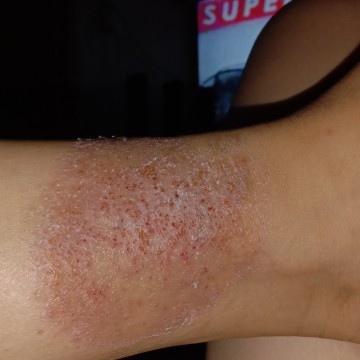 Rashes?