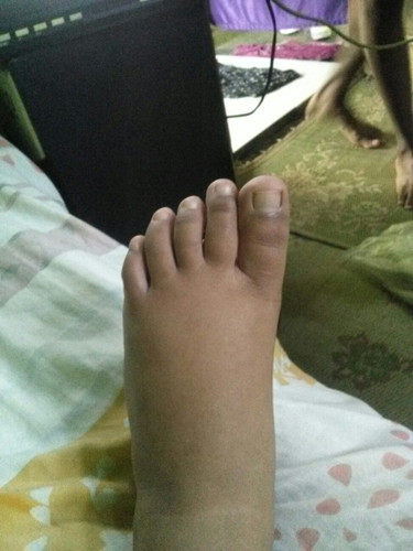 Kaki bengkak?