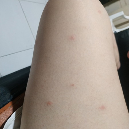 rashes?
