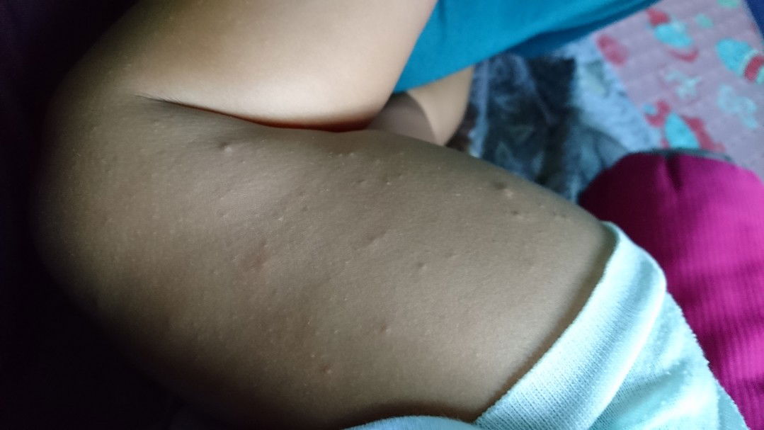 Kulit Muncul Bintik Merah