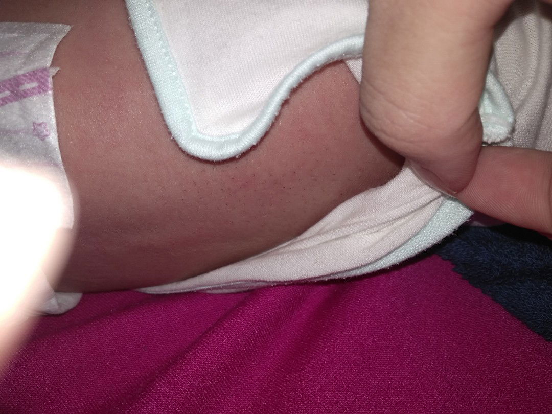 mụn đầu đen trên lưng trẻ sơ sinh