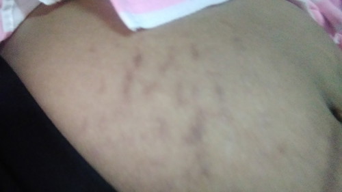 แม่ๆคนไหนท้องลายกันบ้างไหมค่ะ แล้วคลอดแล้วจะหายรึเปล่า พอดีท้องแรกค่ะ