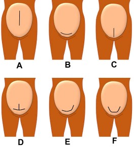 VBAC after inverted T incision