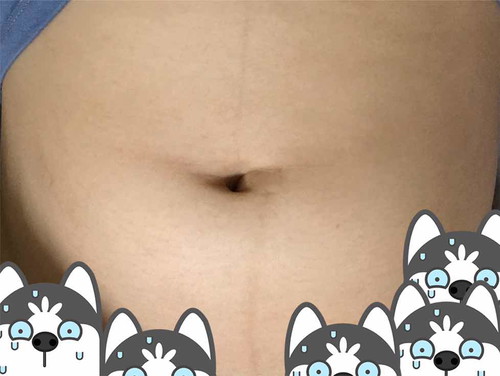 สอบถามแม่ๆ เรื่องเส้นกลางท้องค่ะ