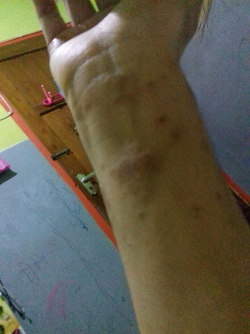 Gatal,perih,kulit seperti terbakar dan kemudian terkelupas  perih,kulit seperti terbakar dan kemudian terkelupas  seluruh badan