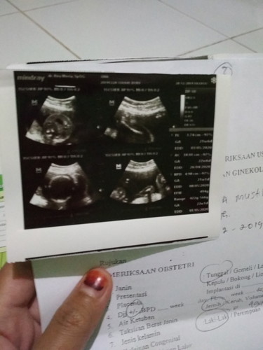 saya hamil 5 bulan ...saya udah cek USG..katanya posisi bayi saya kepalanya di pinggul itu gpp dok..??