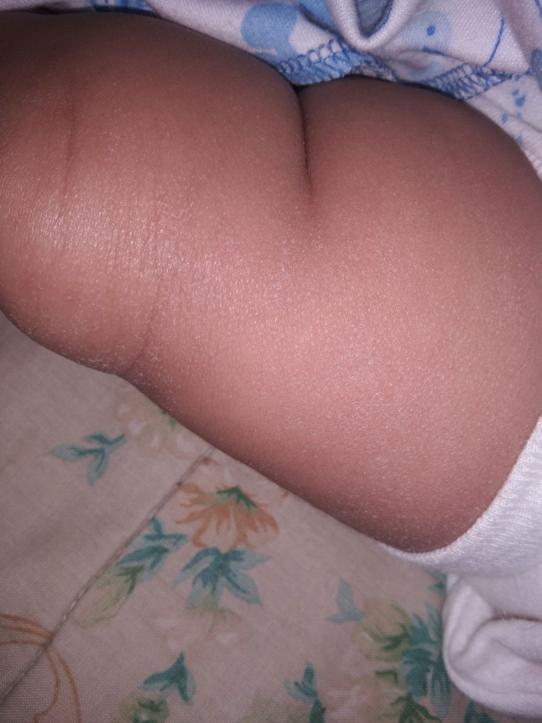 kulit kering pada kulit bayi