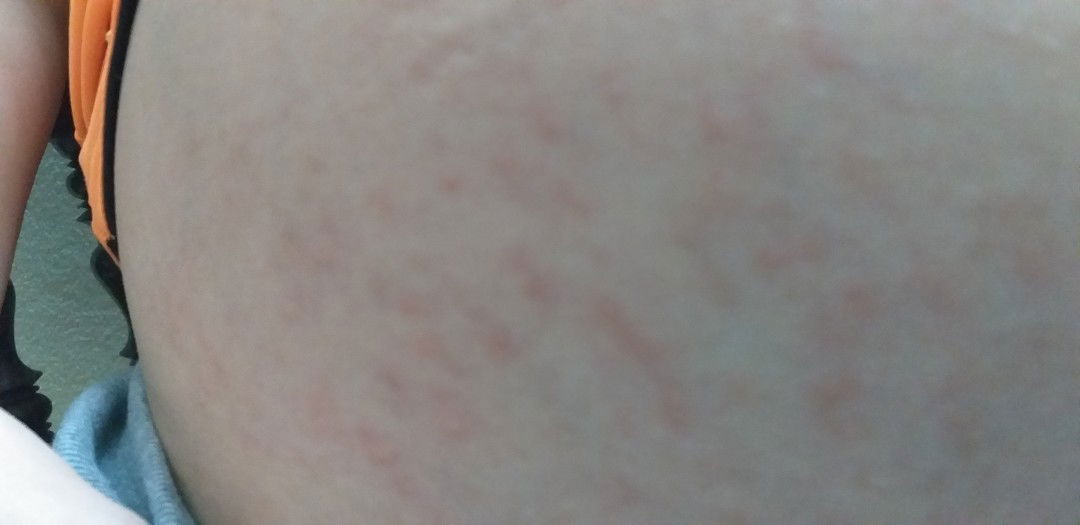 mẩn ngứa ở bụng tuần thứ 33 của thai kỳ