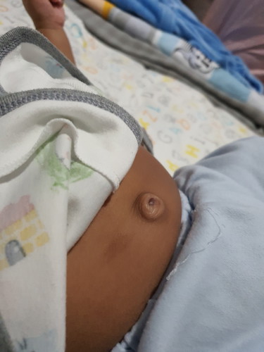 hernia umbilikalis atau benjolan d pusar