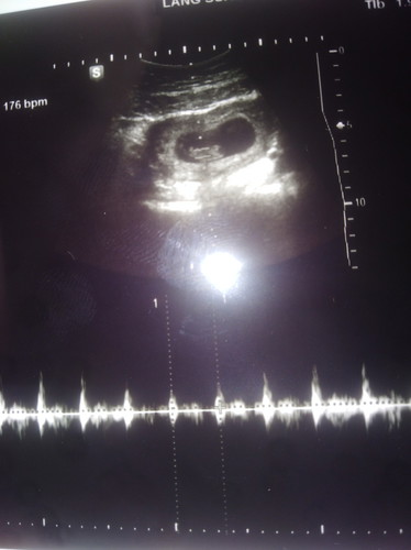 ตั้งครรภ์