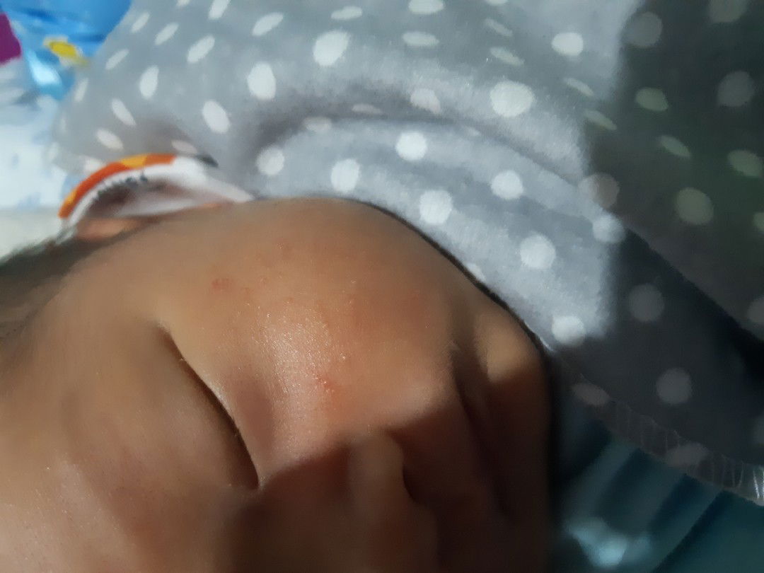Bintik" merah di pipi bayi baru lahir pake apa?
