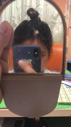 หัวล้าน